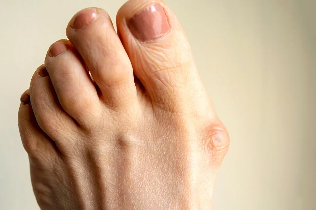 Can Bunions Be Treated Without Surgery?