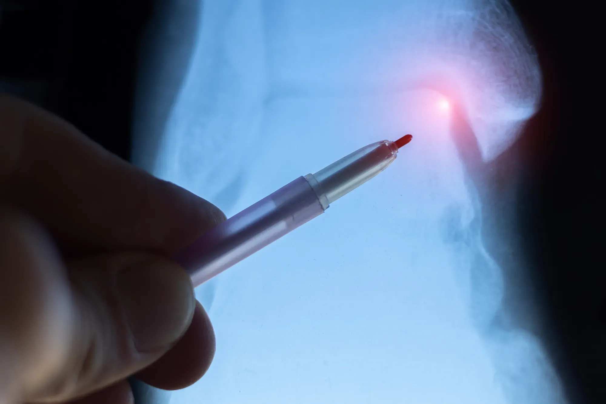 What Are the Early Signs of a Stress Fracture?
