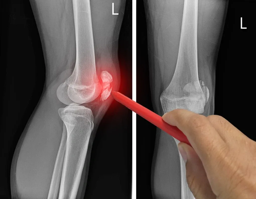 Comprehensive Guide to Patella Fractures (Kneecap Fractures)