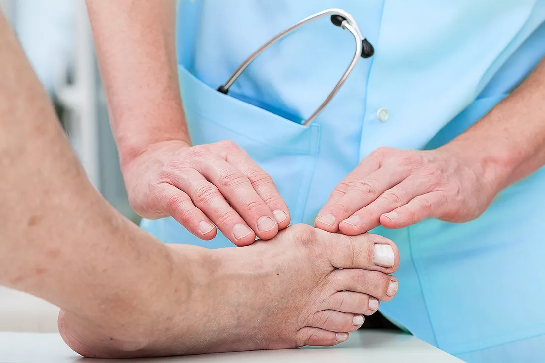 When a Bunion Requires Orthopaedic Care