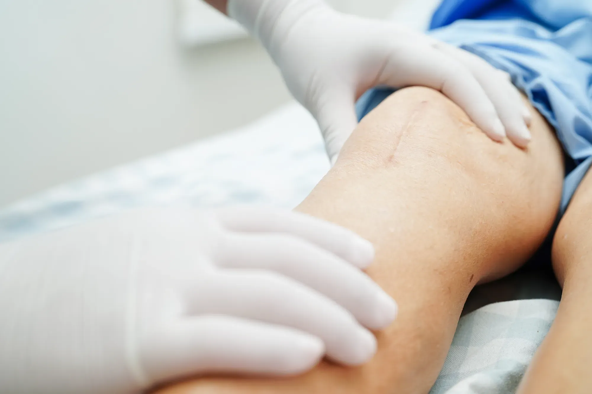 Knee Replacement Surgery: How to Prepare and What to Expect