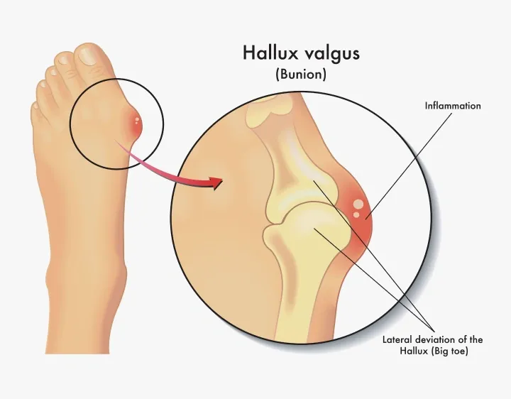 Medical diagram showing hallux valgus anatomy, with a zoomed-in illustration labeling the inflammation and lateral deviation of the big toe bone.