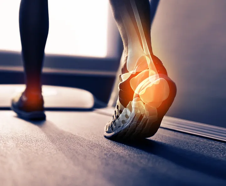Close-up from behind of a runner on a treadmill with a digital skeleton overlay and a red glow highlighting heel bone pain.
