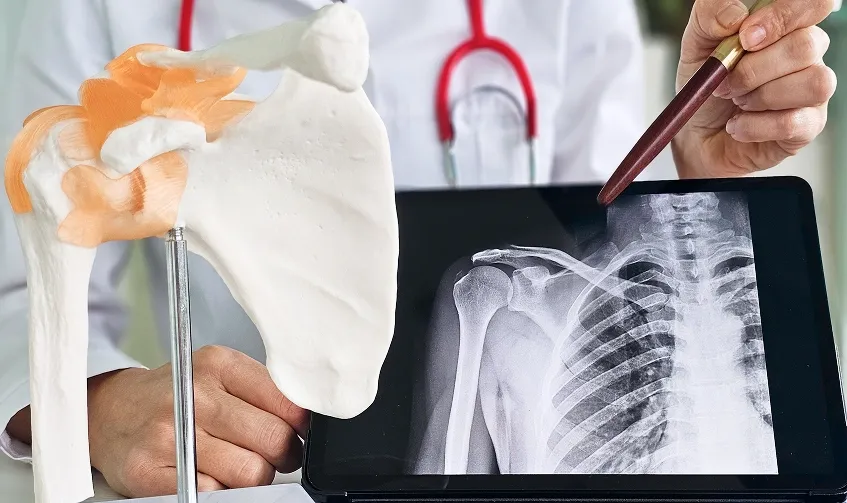 Orthopaedic specialist explaining a shoulder X-ray using a shoulder joint anatomy model during a patient consultation.